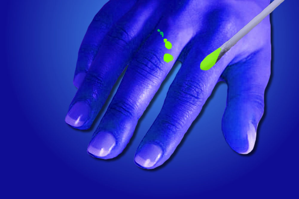 fluorescent dye causes lacerations and tears on the skin to light up