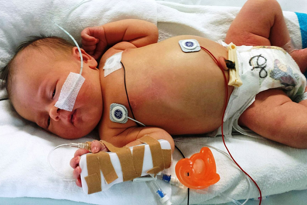 An ill newborn infant in a hospital bed with wires and tubes and monitors.